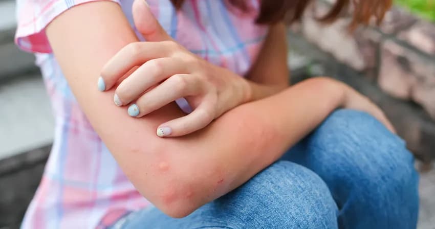 Infected Insect Bite